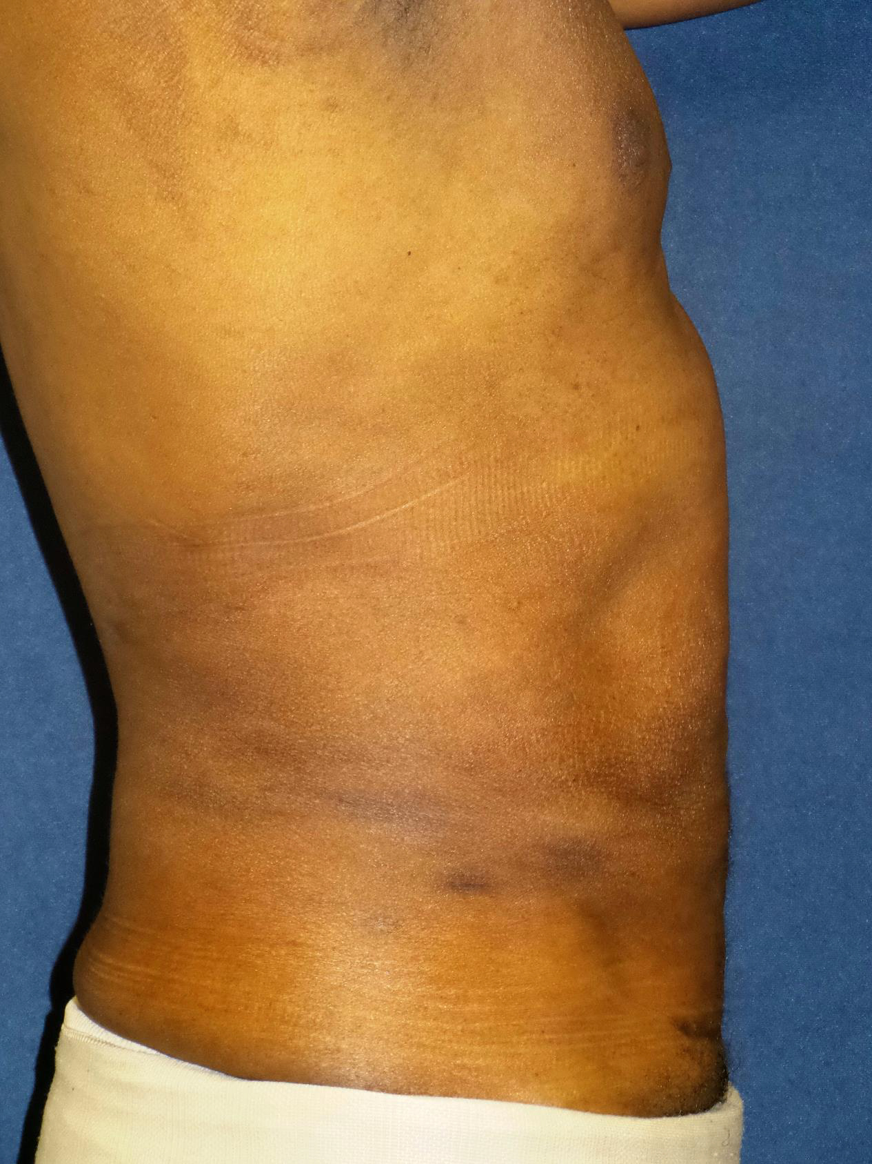 Liposuction Before & After Patient #2126
