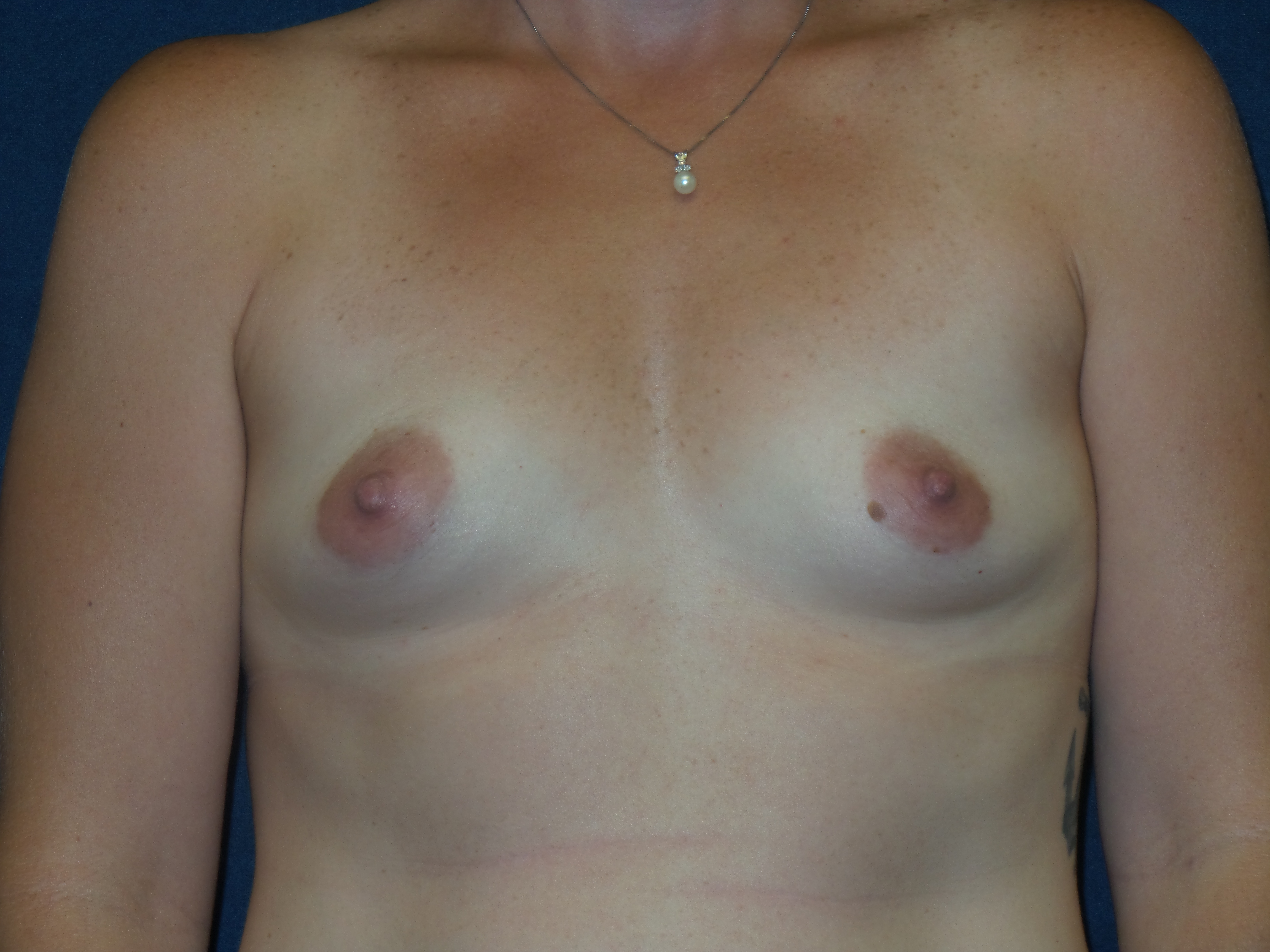 Breast Augmentation Before & After Patient #2169