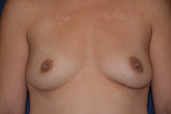 Breast Augmentation Before & After Patient #2376