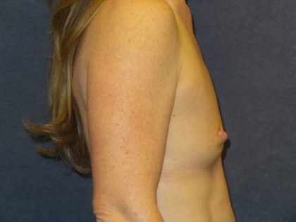 Breast Augmentation Before & After Patient #2394