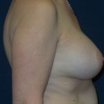 Breast Augmentation Before & After Patient #2399