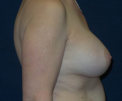 Breast Augmentation Before & After Patient #2399