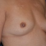 Breast Augmentation Before & After Patient #2376