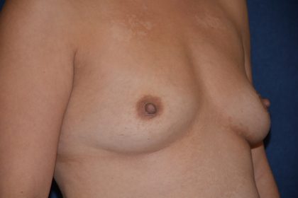 Breast Augmentation Before & After Patient #2376