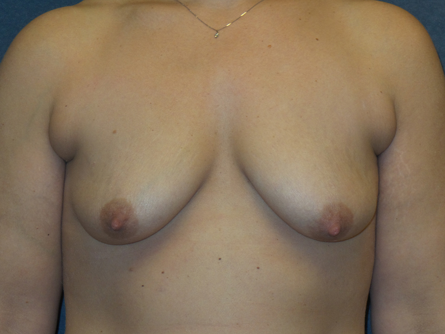Breast Augmentation Before & After Patient #2679