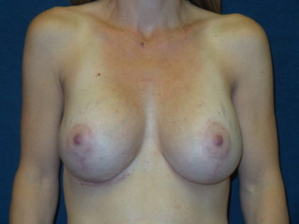 Breast Reagumentation Before & After Patient #2694