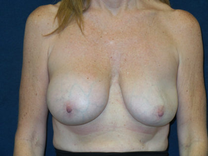 Breast Lift Before & After Patient #2710