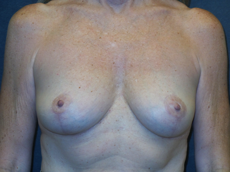 Breast Reagumentation Before & After Patient #2710