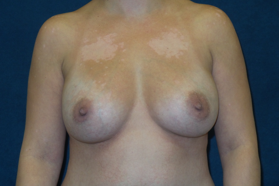 Breast Augmentation Before & After Patient #2726
