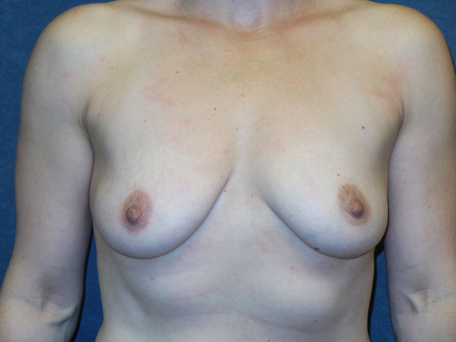 Breast Augmentation Before & After Patient #2746