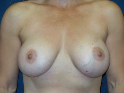 Breast Augmentation Before & After Patient #2746