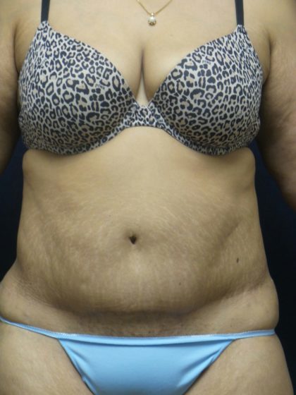 Tummy Tuck Before & After Patient #2682