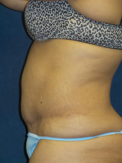 Tummy Tuck Before & After Patient #2682