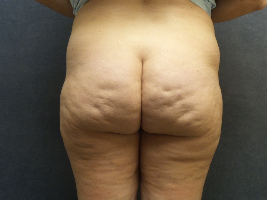 Cellfina Before & After Patient #2723