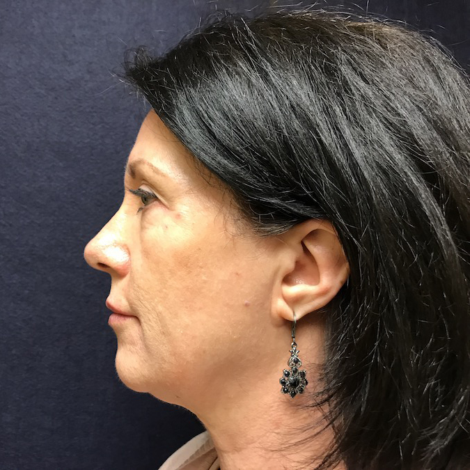 Dermal Fillers Before & After Patient #2757