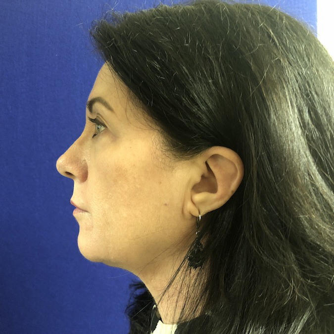 Dermal Fillers Before & After Patient #2757