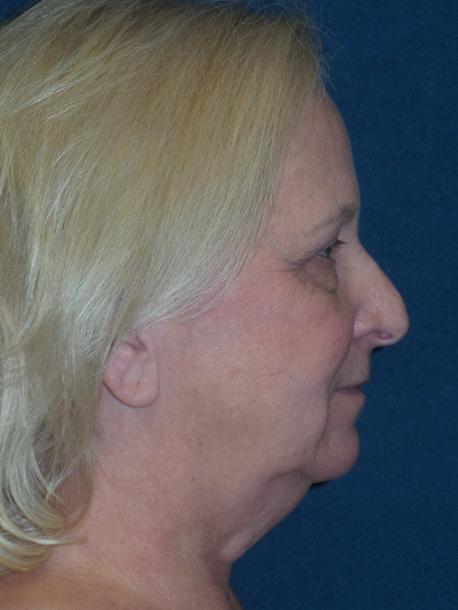 Facelift Before & After Patient #2689