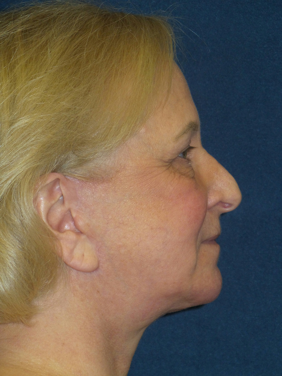 Facelift Before & After Patient #2689