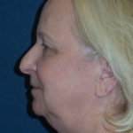 Facelift Before & After Patient #2689