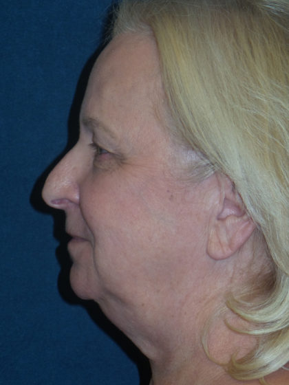 Facelift Before & After Patient #2689