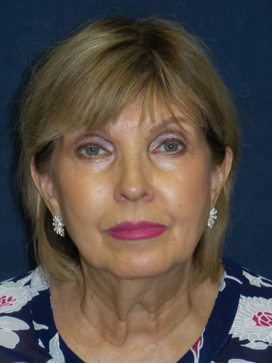 Facelift Before & After Patient #2715