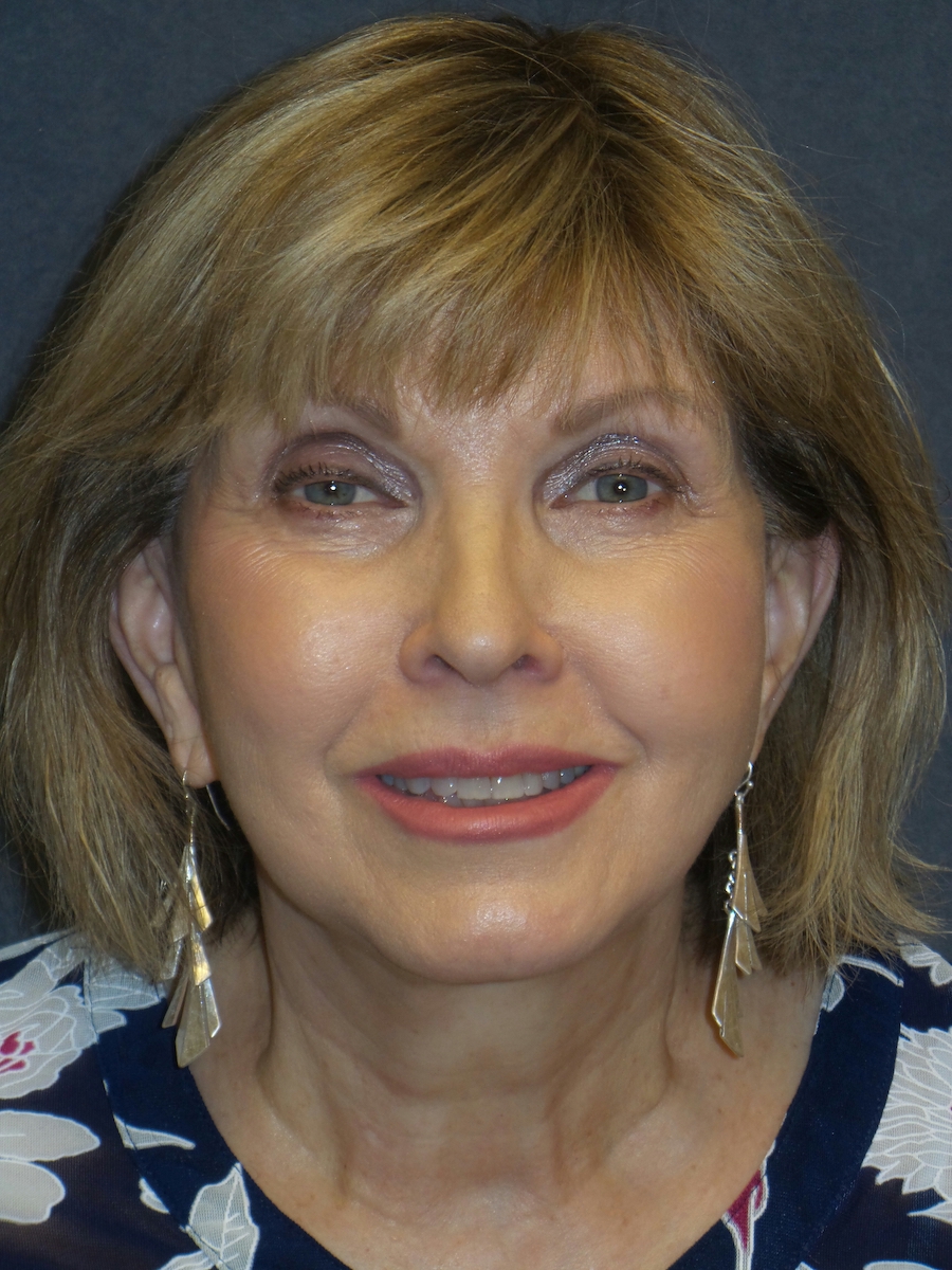 Facelift Before & After Patient #2715