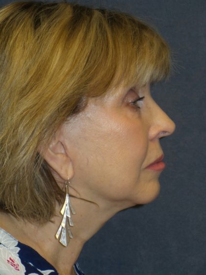 Facelift Before & After Patient #2715