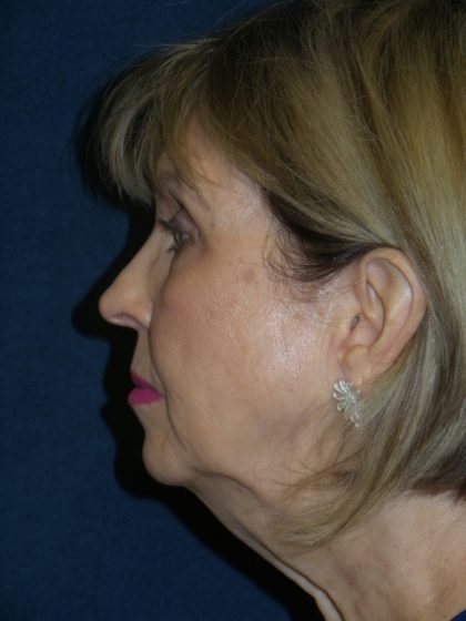 Facelift Before & After Patient #2715