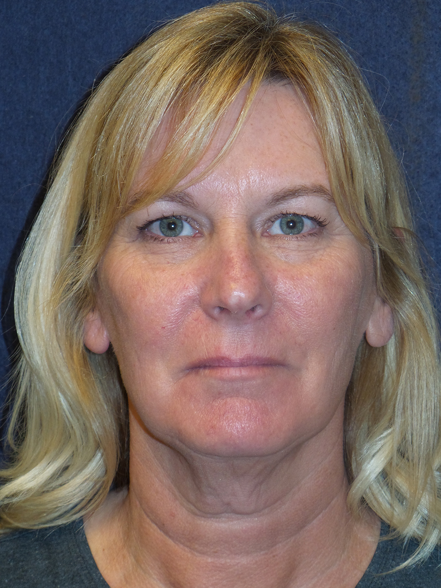 Facelift Before & After Patient #2731