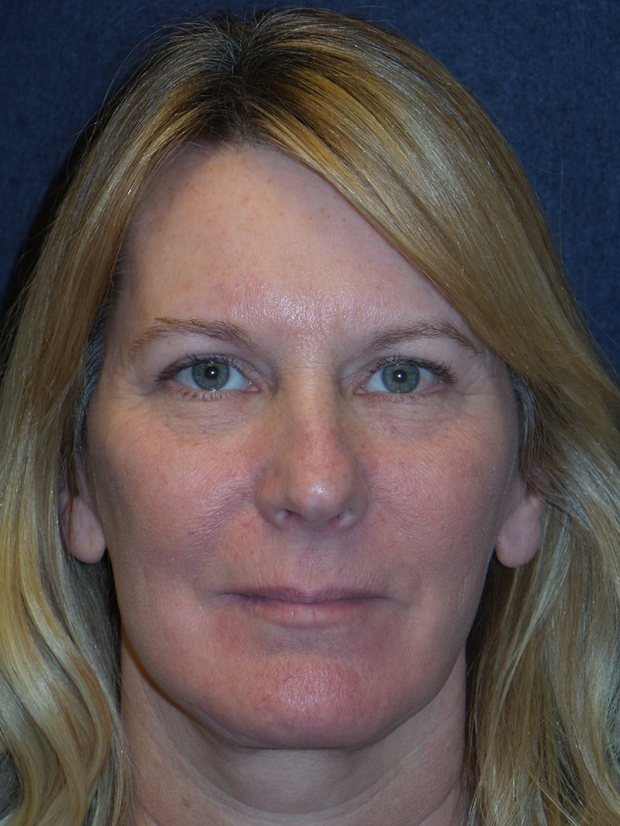 Facelift Before & After Patient #2731