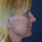 Facelift Before & After Patient #2731