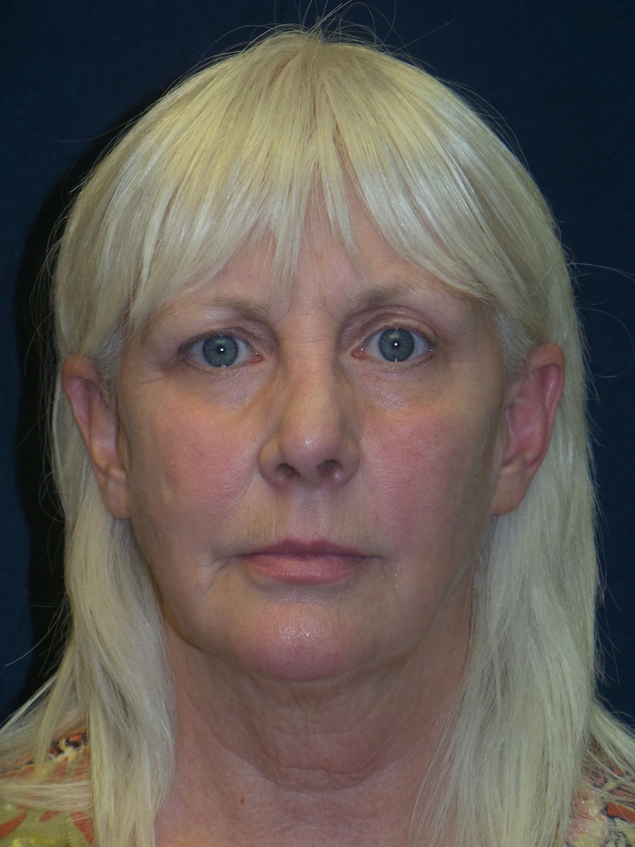 Facelift Before & After Patient #2736