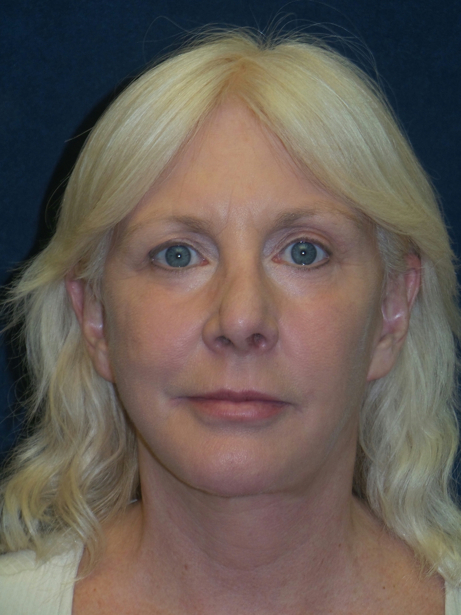 Facelift Before & After Patient #2736