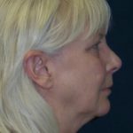 Facelift Before & After Patient #2736