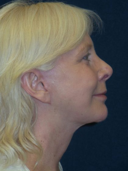 Facelift Before & After Patient #2736