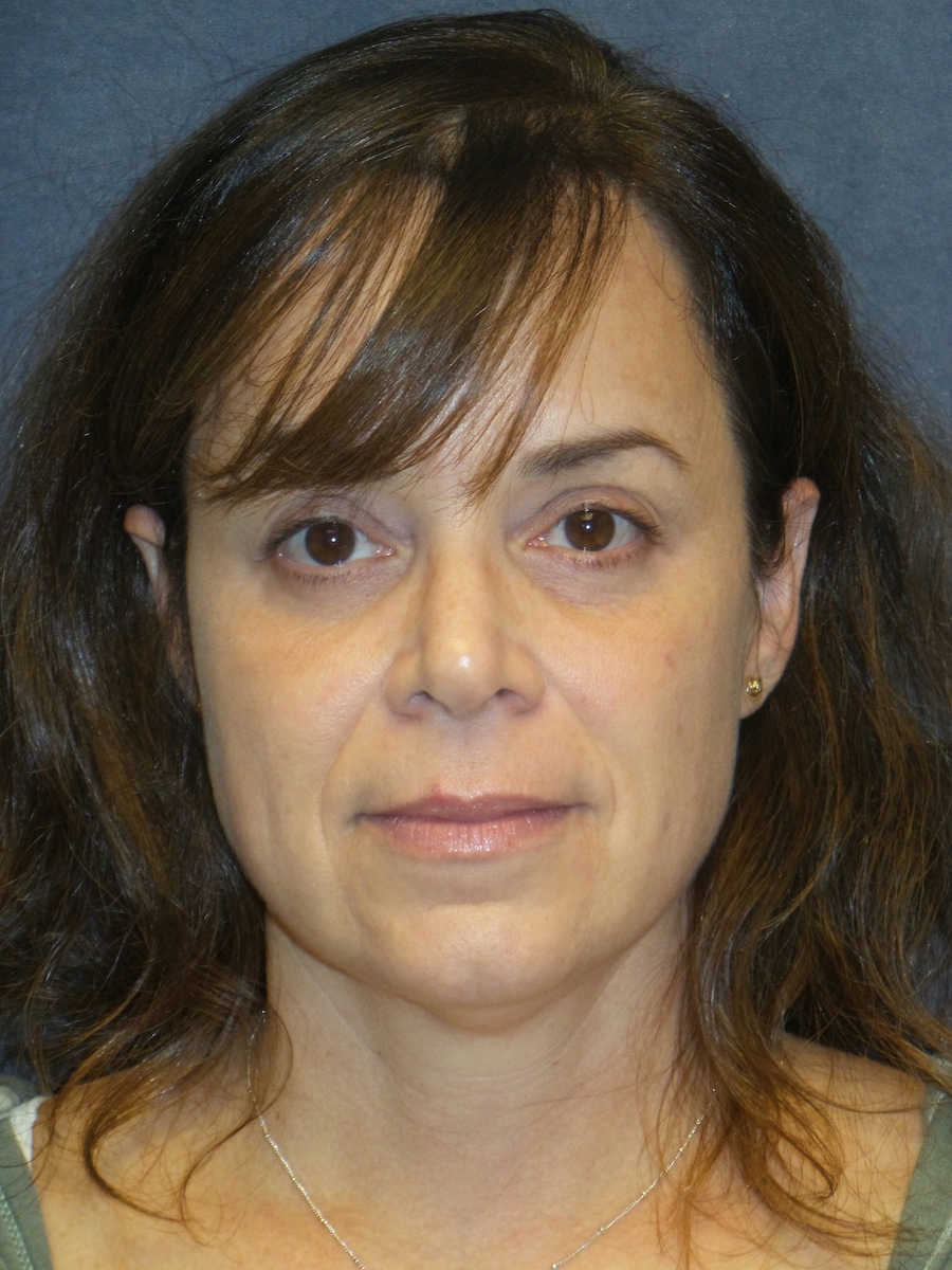 Neck Lift Before & After Patient #2741