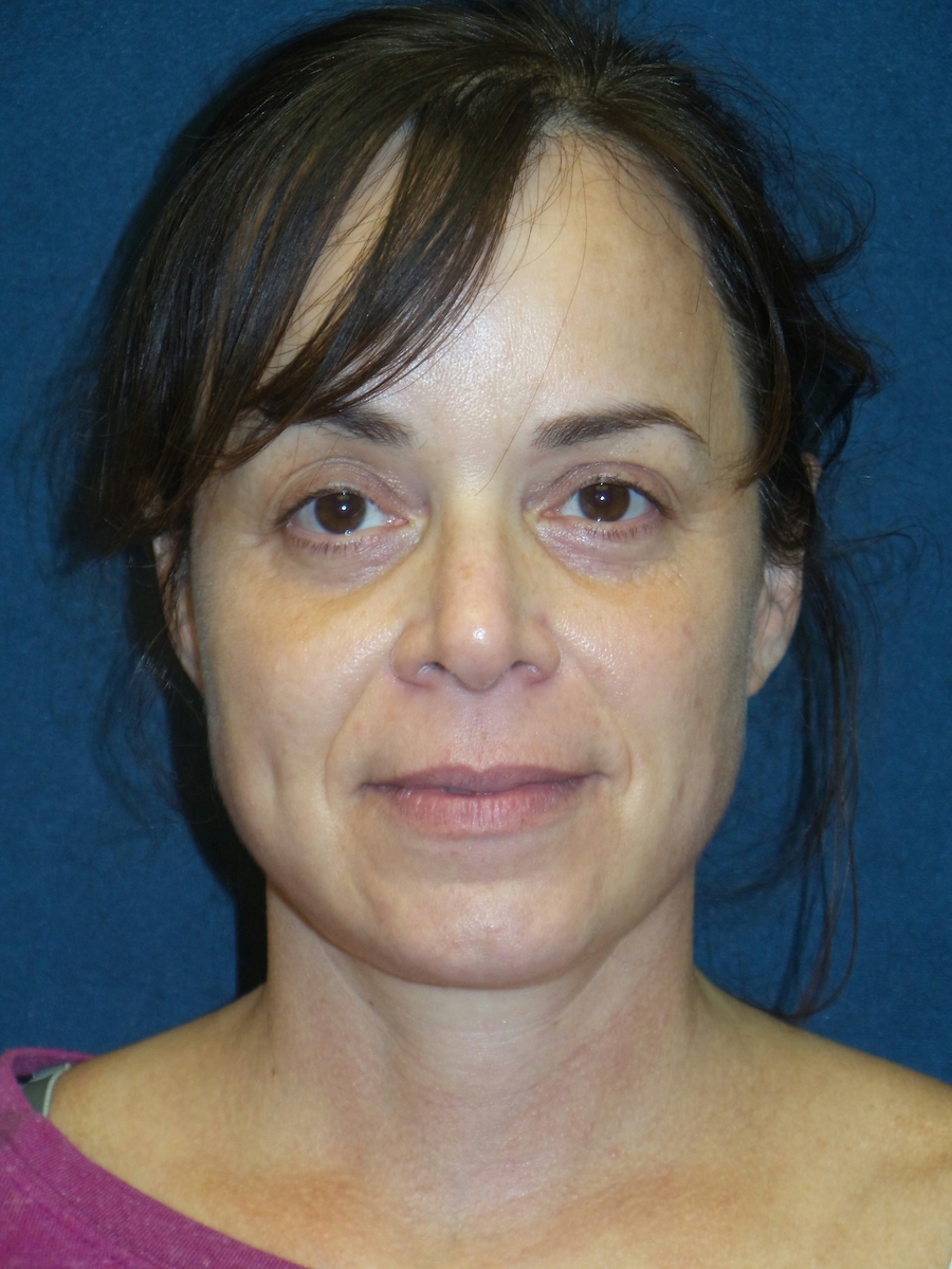 Neck Lift Before & After Patient #2741