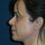 Neck Lift Before & After Patient #2741