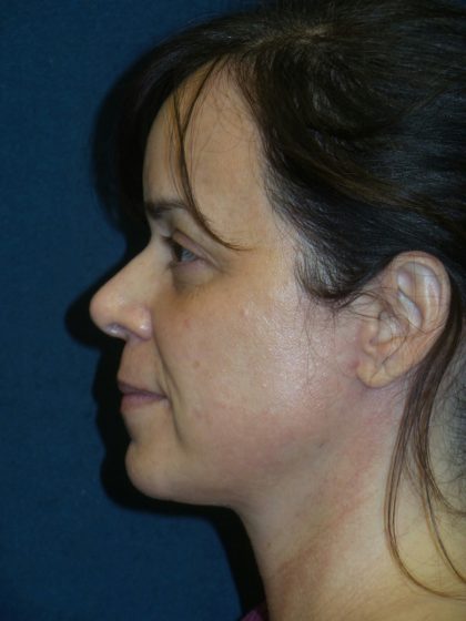 Neck Lift Before & After Patient #2741