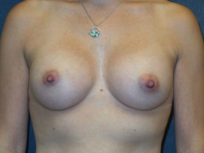 Breast Augmentation Before & After Patient #2813