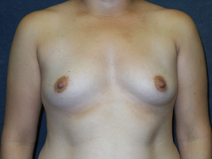 Breast Augmentation Before & After Patient #2820