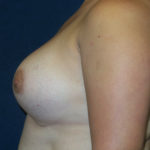 Breast Augmentation Before & After Patient #2820