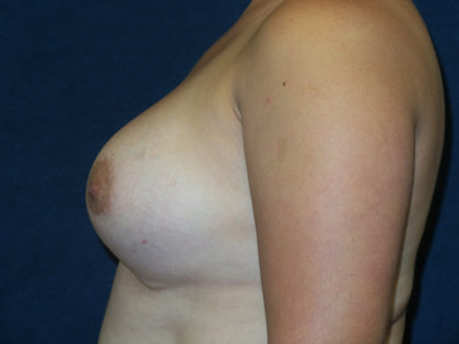 Breast Augmentation Before & After Patient #2820