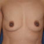 Breast Augmentation Before & After Patient #2827