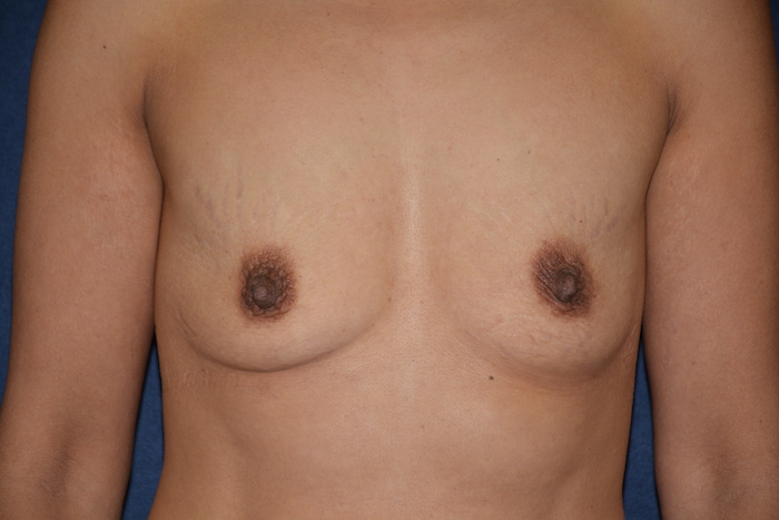 Breast Augmentation Before & After Patient #2827
