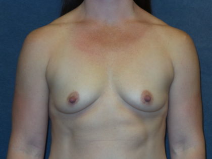 Breast Augmentation Before & After Patient #2764