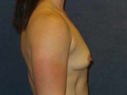 Breast Augmentation Before & After Patient #2764