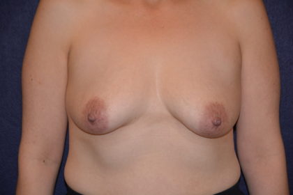 Breast Augmentation Before & After Patient #2773