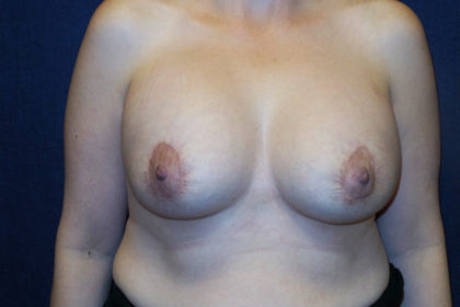 Breast Augmentation Before & After Patient #2773