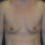 Breast Augmentation Before & After Patient #2799